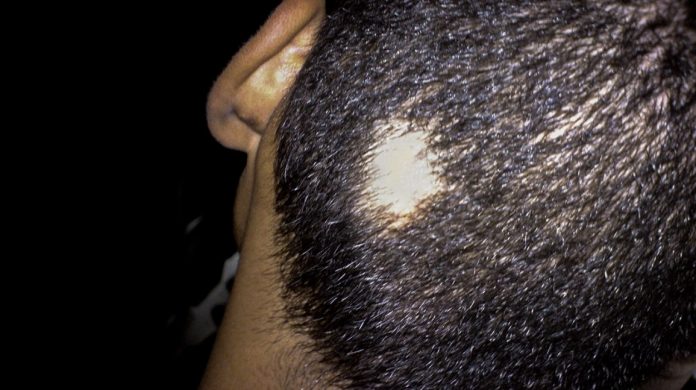Health Beat: Alopecia Areata, Causes, Diagnosis and ...