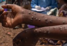 Kisumu confirms first MPOX case as health department issues alert