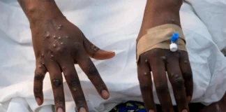 Kenya on high alert after deadly Marburg outbreak in Ethiopia