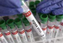 Mpox outbreak confirmed in Embu County as health officials intensify response
