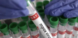 Mpox outbreak confirmed in Embu County as health officials intensify response