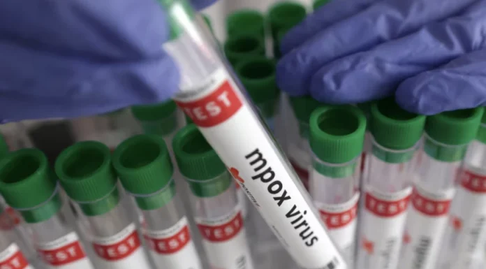 Mpox outbreak confirmed in Embu County as health officials intensify response